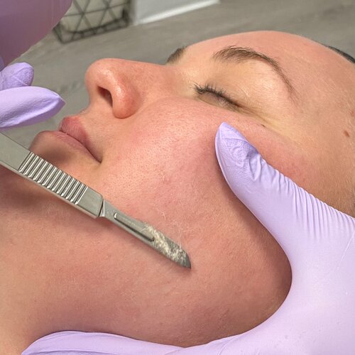 A dermaplaning blade drawn across a patient’s cheek